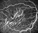 esame ICGA angiografia con verde di indocianina