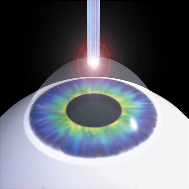 Con il laser si può modellare la cornea per poter correggere miopia, ipermetropia o astigmatismo; nell'immagine la tecnica PRK