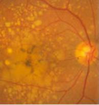 patologia della retina: degenerazione maculare legata all'età di tipo secco