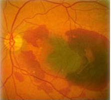 patologia della retina: degenerazione maculare legata all'età di tipo essudativo