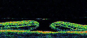 oct, strumento che esegue la tomografia della retina