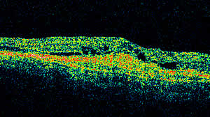 oct, strumento che esegue la tomografia della retina