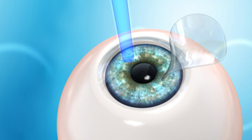 intervento di chirurgia refrattiva con tecnica LASIK