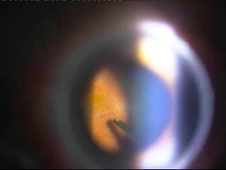 chirurgia vitreo-retinica, vitrectomia